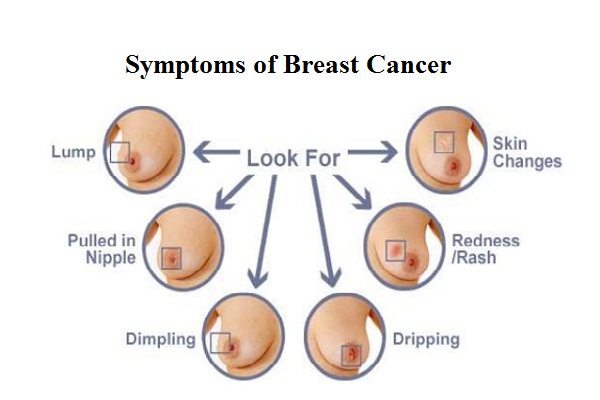 Symptoms-of-Breast-Cancer