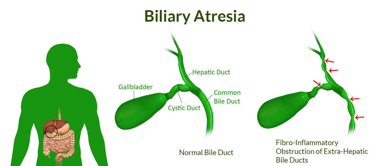 Biliary-Atresia